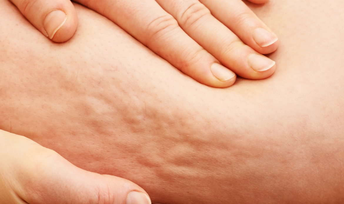 Beneficios de la presoterapia en la reducción de la celulitis
