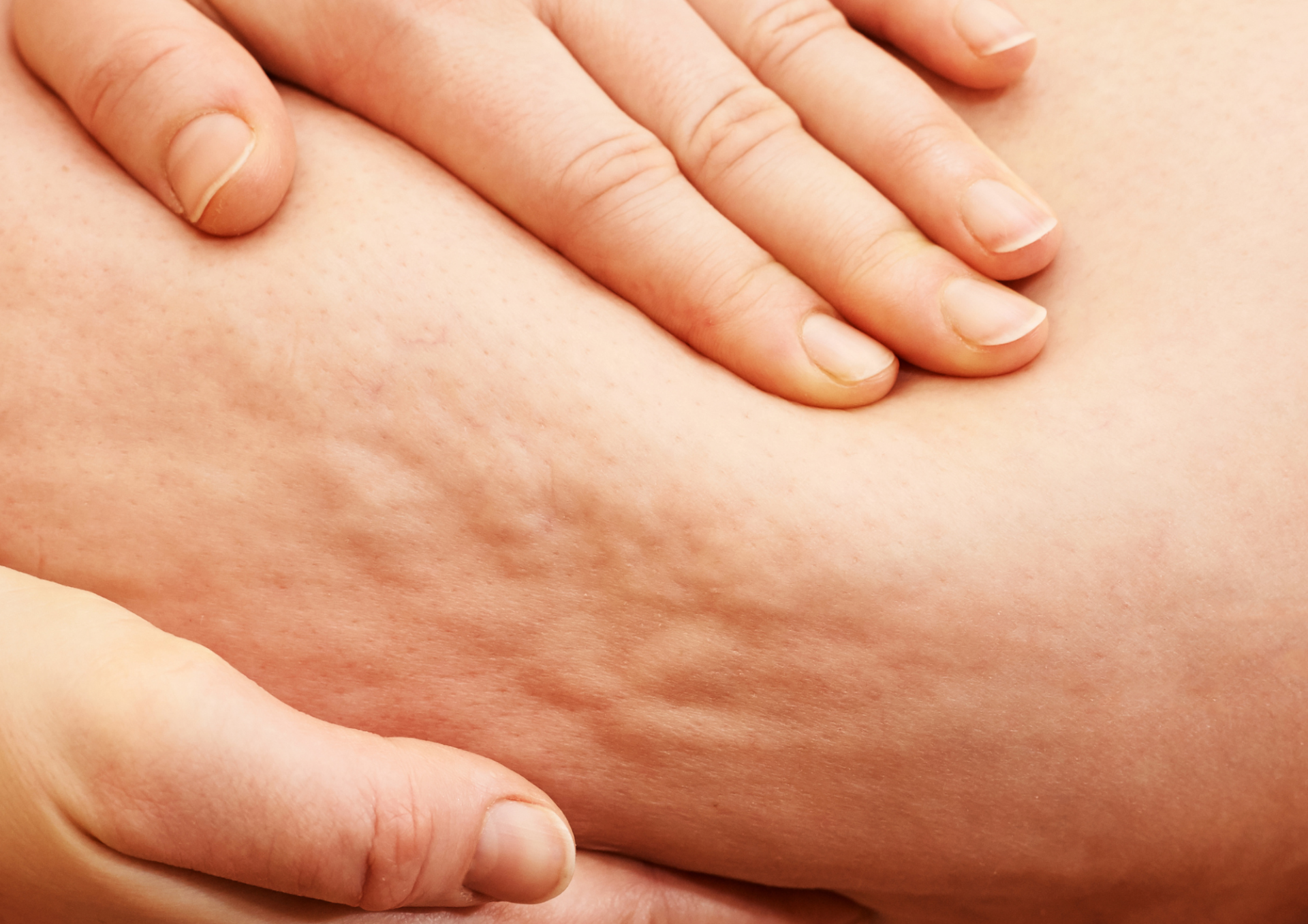 Beneficios de la presoterapia en la reducción de la celulitis