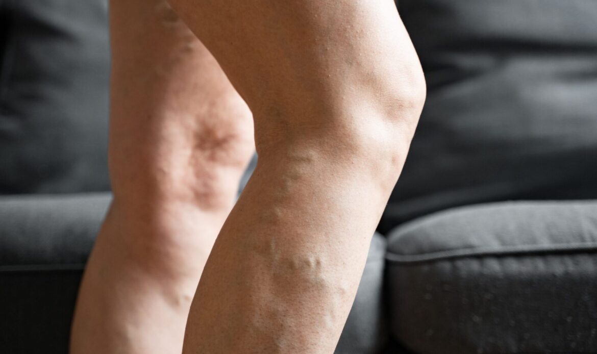 Presoterapia y Lipedema: Guía completa para Reducir el dolor, la inflamación y Mejorar tu calidad de vida