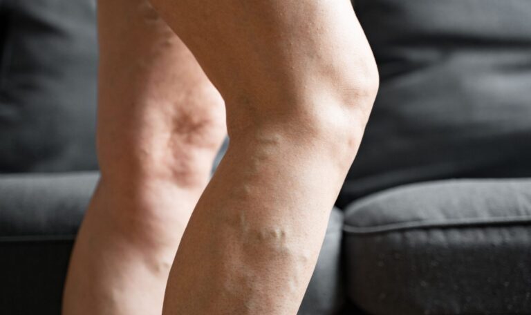 Presoterapia y Lipedema: Guía completa para Reducir el dolor, la inflamación y Mejorar tu calidad de vida