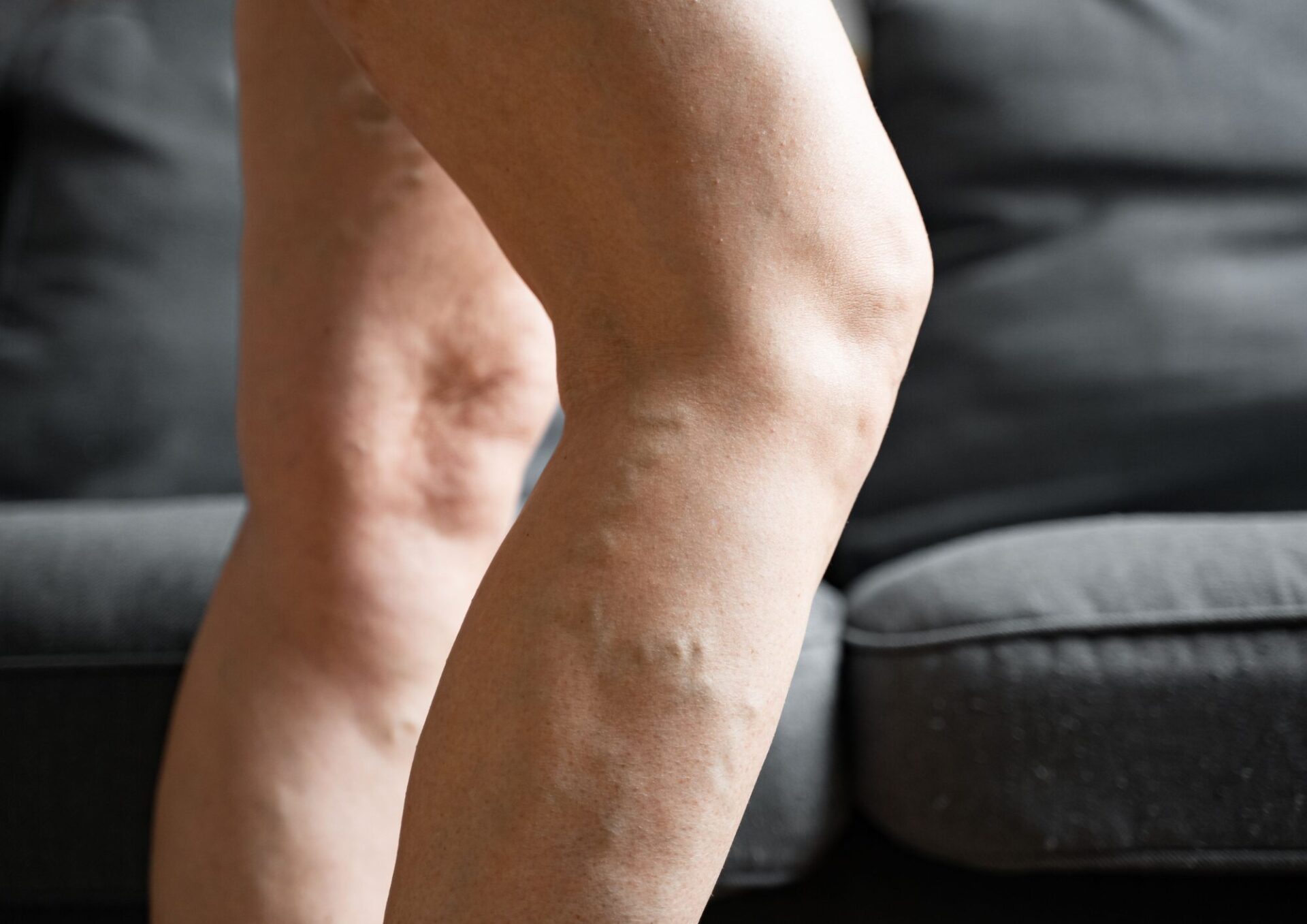 Presoterapia y Lipedema: Guía completa para Reducir el dolor, la inflamación y Mejorar tu calidad de vida