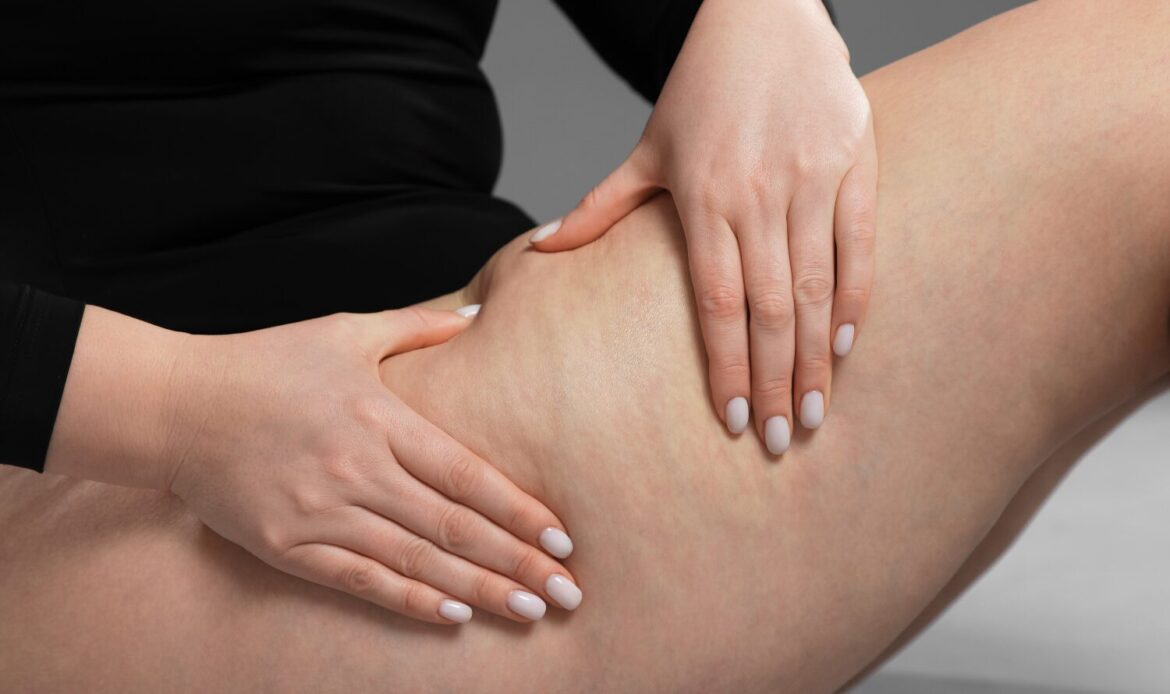 Presoterapia y celulitis cómo mejorar el aspecto de la piel de forma eficaz y no invasiva