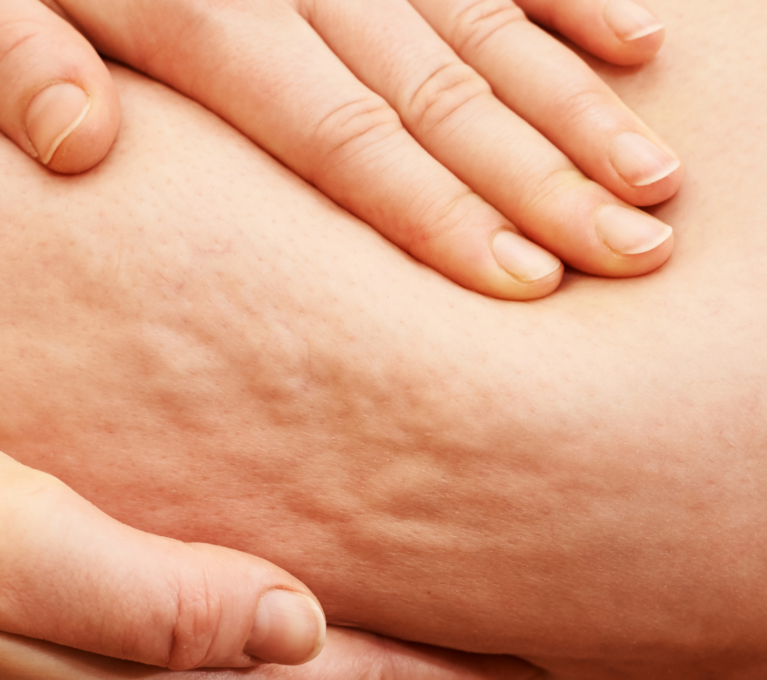 Beneficios de la presoterapia en la reducción de la celulitis