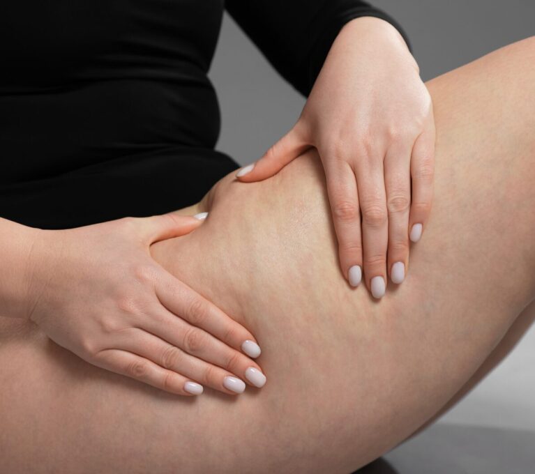 Presoterapia y celulitis cómo mejorar el aspecto de la piel de forma eficaz y no invasiva
