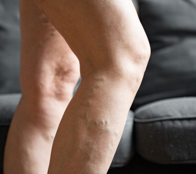 Presoterapia y Lipedema: Guía completa para Reducir el dolor, la inflamación y Mejorar tu calidad de vida